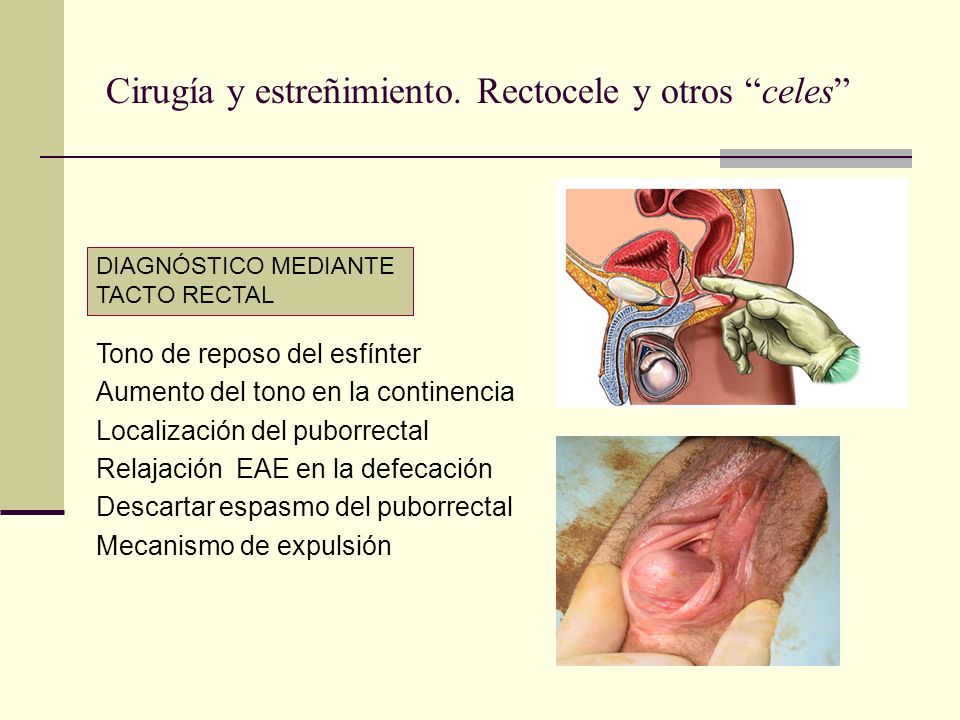 Rectocele sintomas y causas